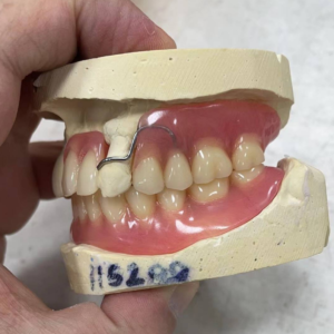 Partial Resin Base Denture