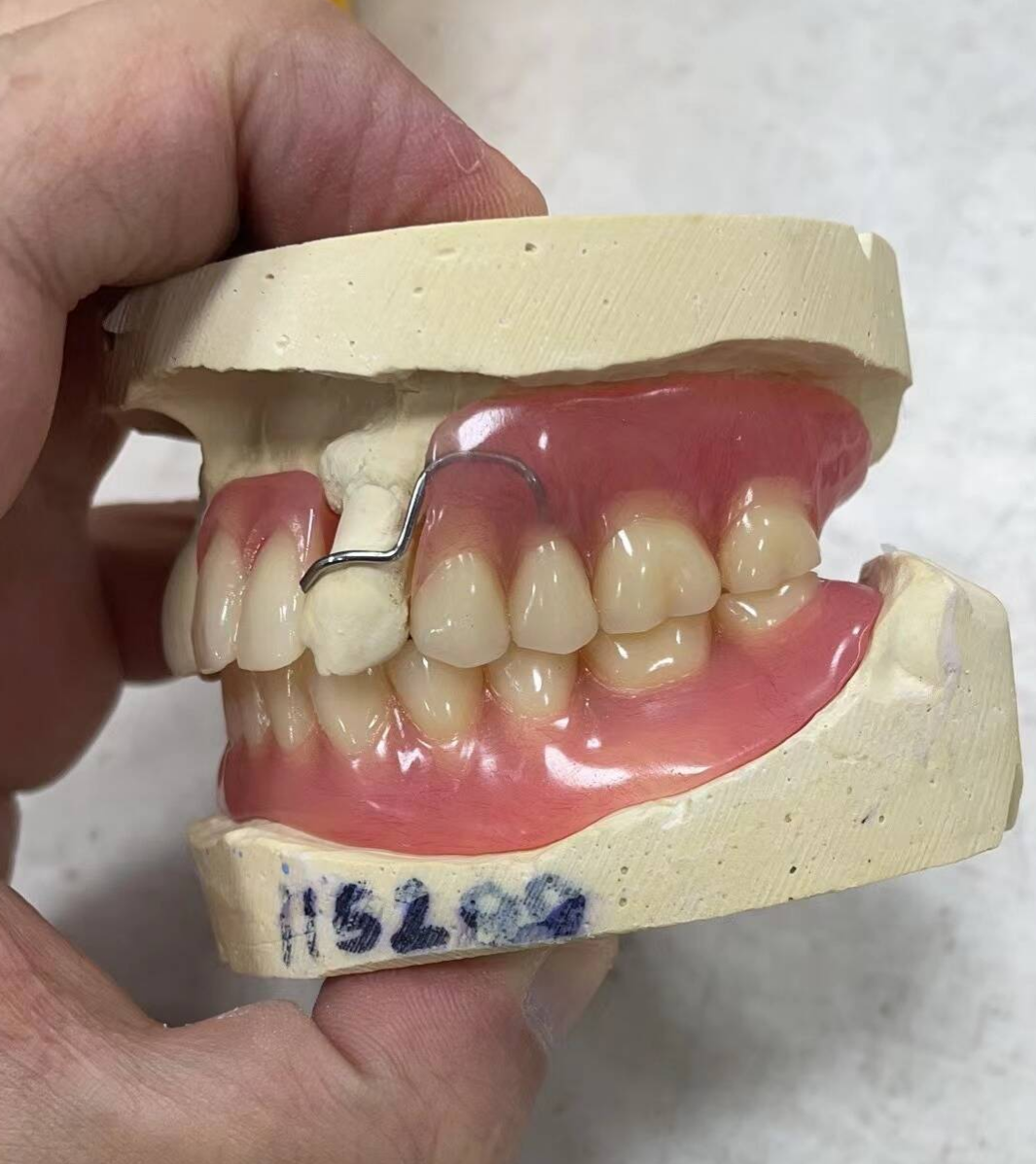 Partial Resin Base Denture