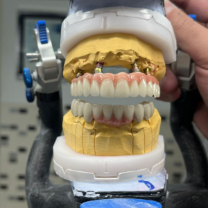 Zirconia Implant Crown (including abutment milling)　