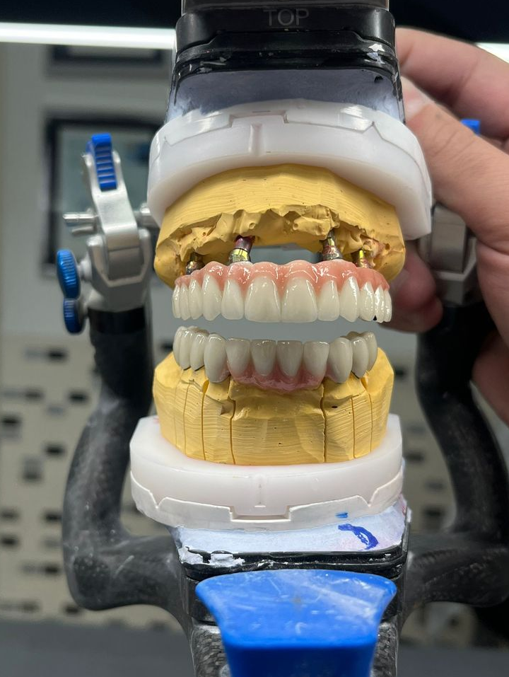 Zirconia Implant Crown (including abutment milling)　