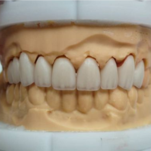 Zirconia All-Ceramic Crown