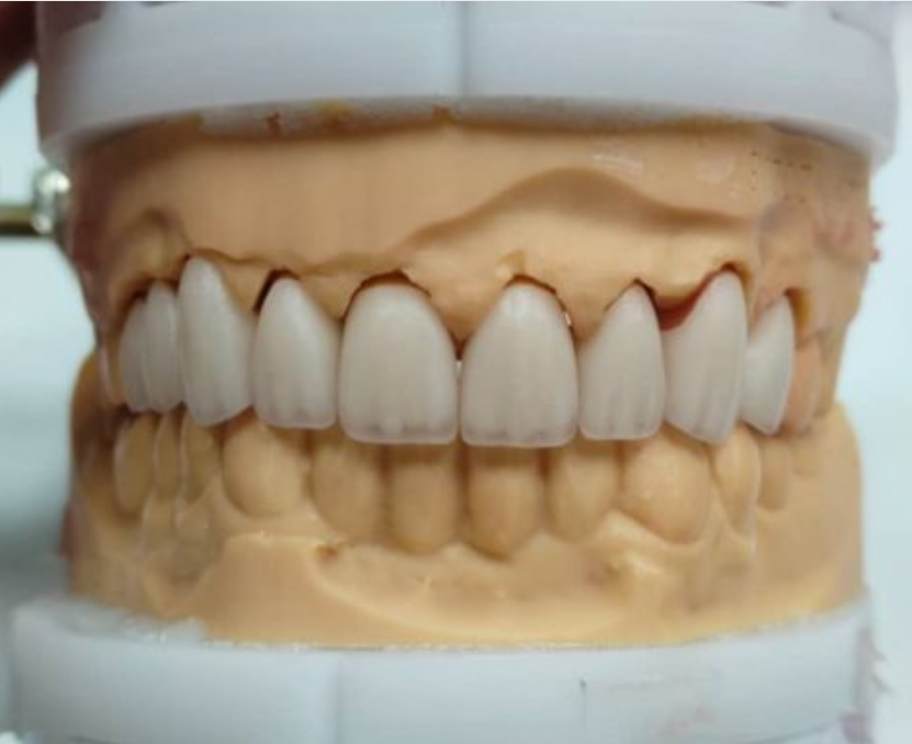 Zirconia All-Ceramic Crown