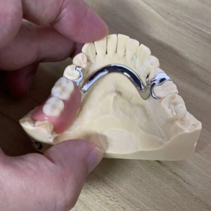 Cobalt-chromium Framework Denture