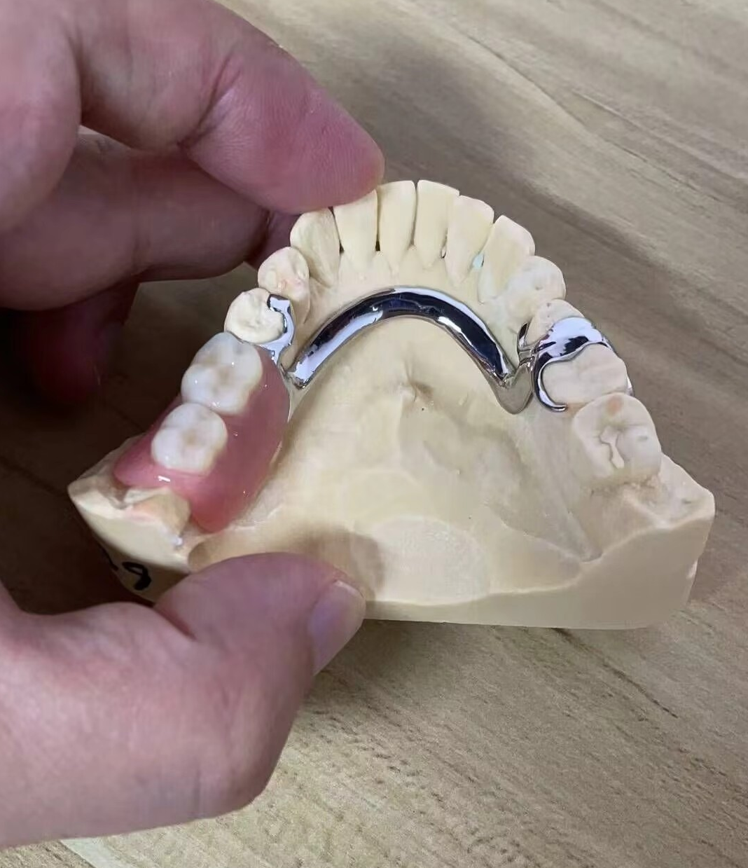 Cobalt-chromium Framework Denture